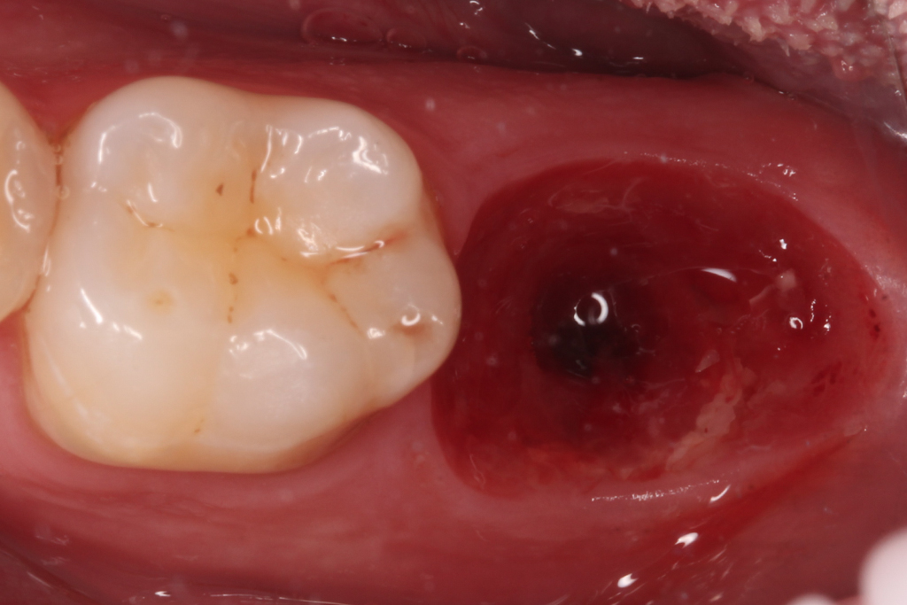 Implantes dentales Cartagena - Clínica Dental Vidal